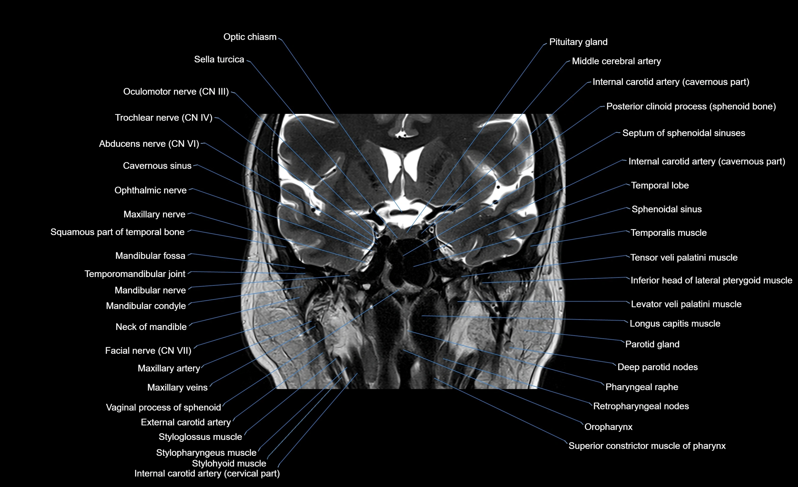 MRI face & paranasal sinuses(PNS) labelled  coronal  cross sectional anatomy 3T radiology  image-img-00001-00036.webp